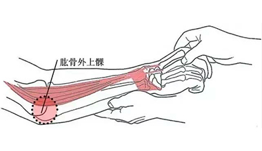 什么是肱骨外上髁炎？多發(fā)于那些人群？